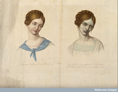 V0010485 A young Viennese woman, aged 23, depicted before and after